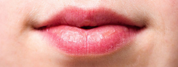 Why Are My Lips Always Dry and Peeling?